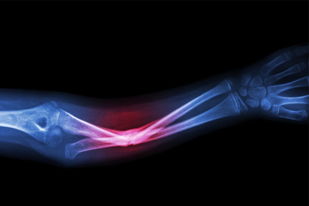 πͺ Elbow Surgery: Expert Care for Pain, Injury & Joint Disorders 2 Elbow surgery consultation at HESS in Lahore